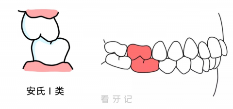 错颌畸形的定义？什么是安氏Ⅰ类Ⅱ类Ⅲ类错颌