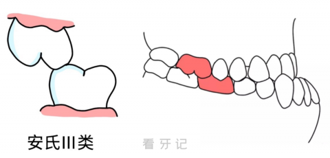 错颌畸形的定义？什么是安氏Ⅰ类Ⅱ类Ⅲ类错颌