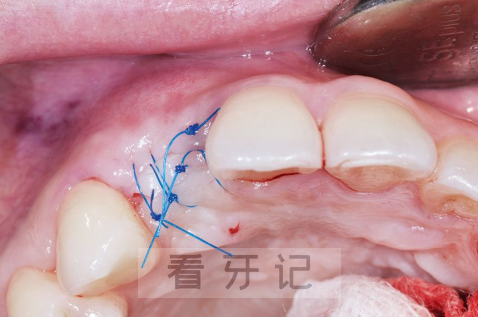 种植牙手术流程真实高清图片有点吓人看着就疼