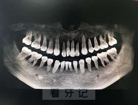 太可怕了才25岁得了牙周炎全口牙齿几乎要拔光