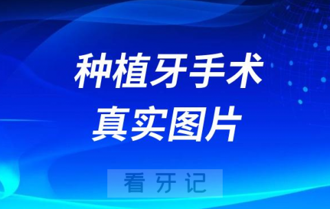 种植牙手术流程真实高清图片有点吓人看着就疼