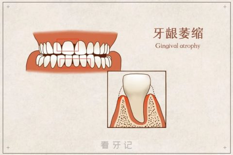 如何判断自己是属于哪一类牙龈萎缩