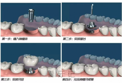 种植牙到底是种的什么牙