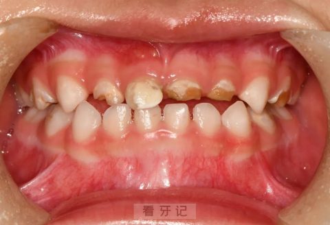 门牙龋齿高清图片