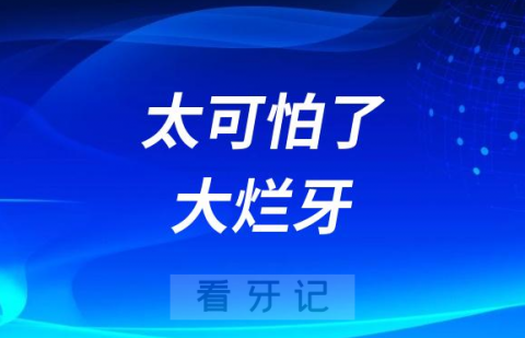 太可怕了大牙烂到这个程度必须要拔了