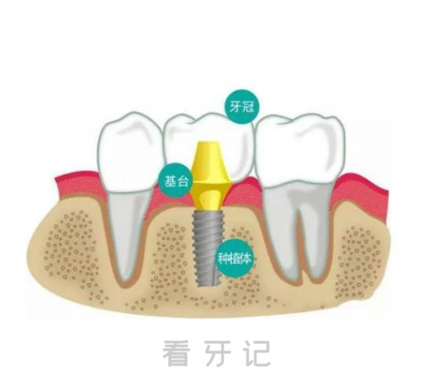 种植牙做核磁共振会发生什么严重后果？