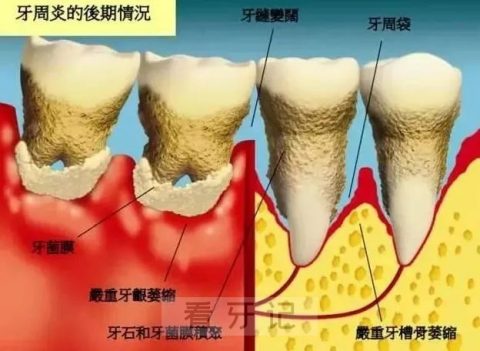 太可怕了！牙周炎牙龈萎缩轻度中度重度图片