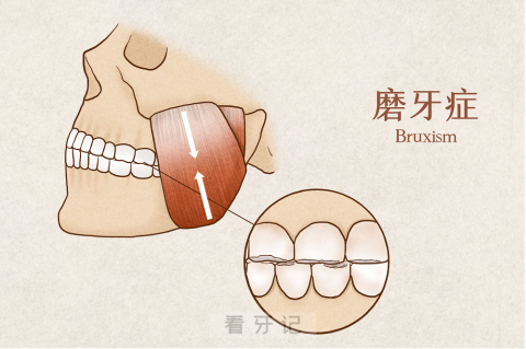 磨牙症三大类型盘点