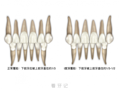 深覆合很可怕吗？一度二度三度定义是什么？附完整对比图