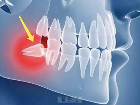 什么是智齿？智齿长什么样图片？最新解读来了