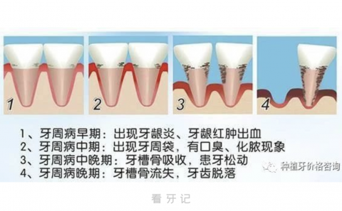 如何判断有没有牙周炎？七大症状对比解读来了