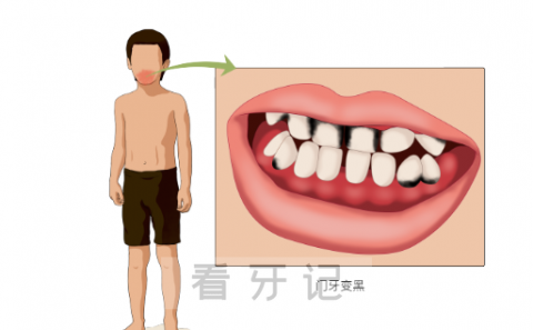 儿童门牙变黑发黑图片