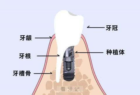 什么是植骨？是不是对身体不好？非常疼？