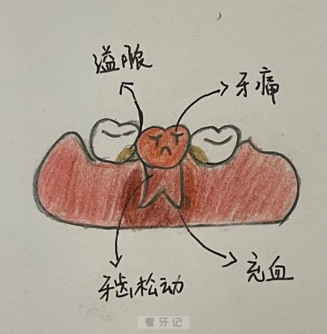 太可怕了！有人竟然得了颌骨骨髓炎