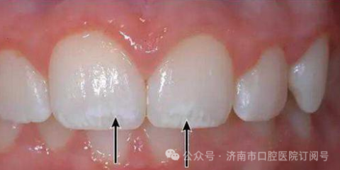 孩子牙齿白斑真实图片