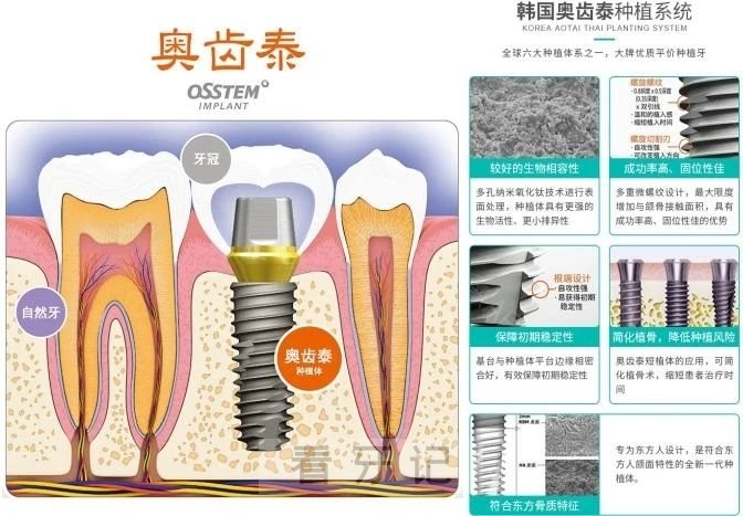 种牙选登腾还是奥齿泰？韩国两大种植体品牌谁是最好的？