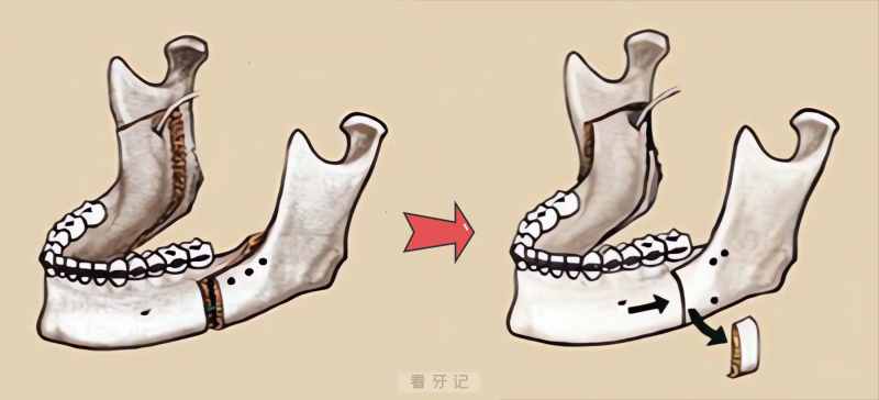 医生为什么建议千万不要去口腔医院正颌