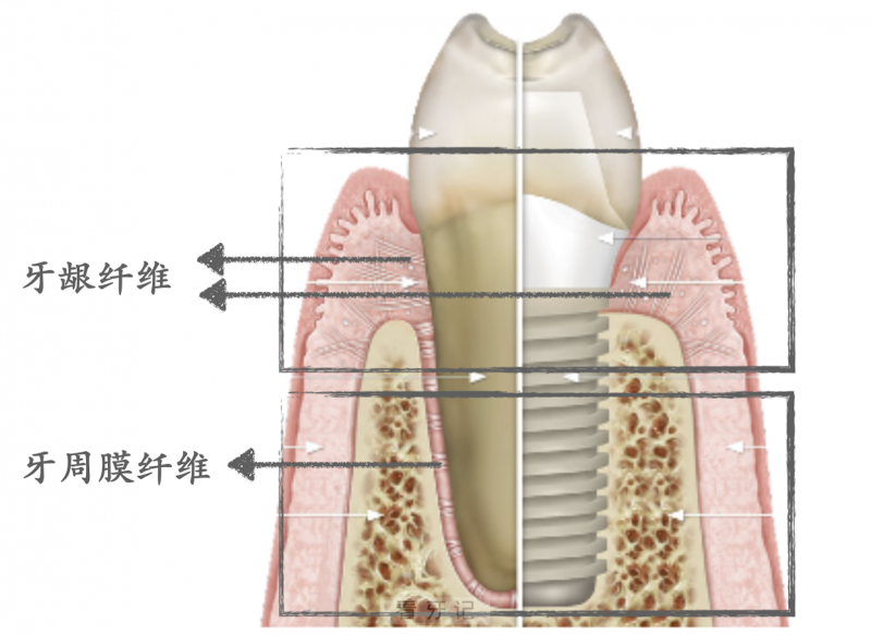 种植牙天然牙结构图对比