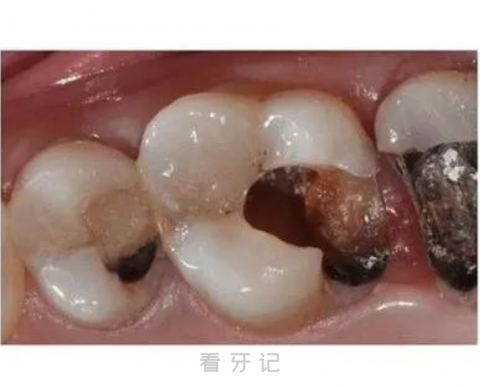 后槽牙烂了个大窟窿还能补牙吗？