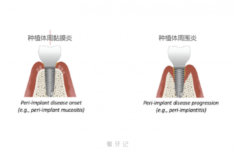 种植体周围炎六大症状表现盘点