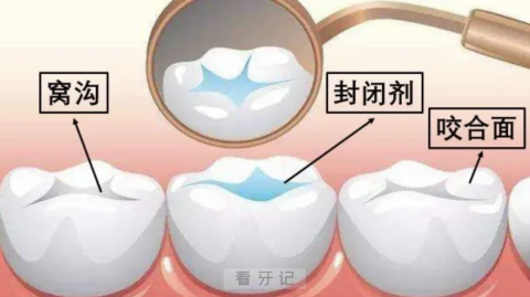 良心牙医告诉你窝沟封闭和全口涂氟有哪些区别