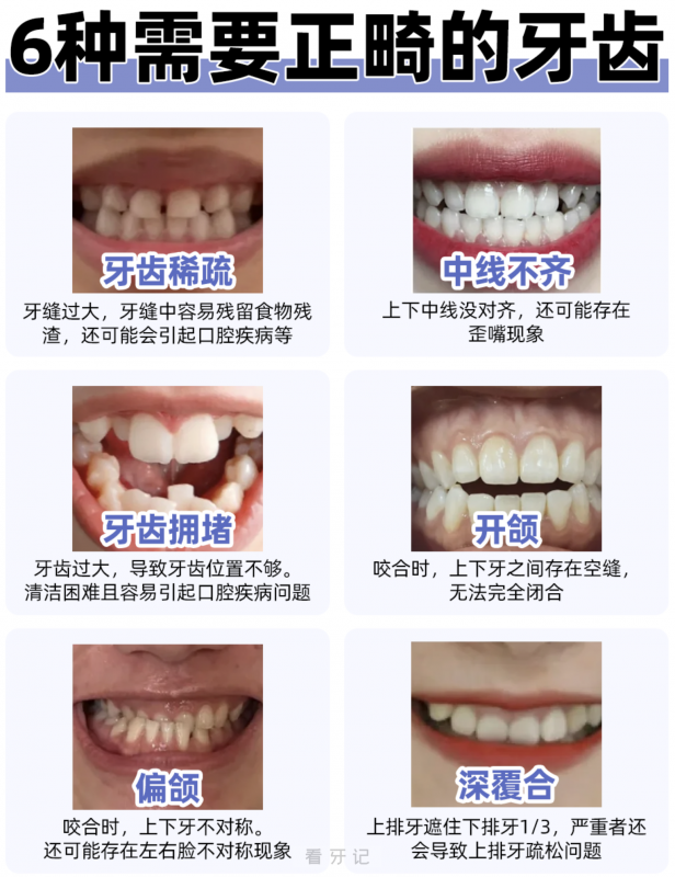 一张图告诉你​牙齿要不要做正畸