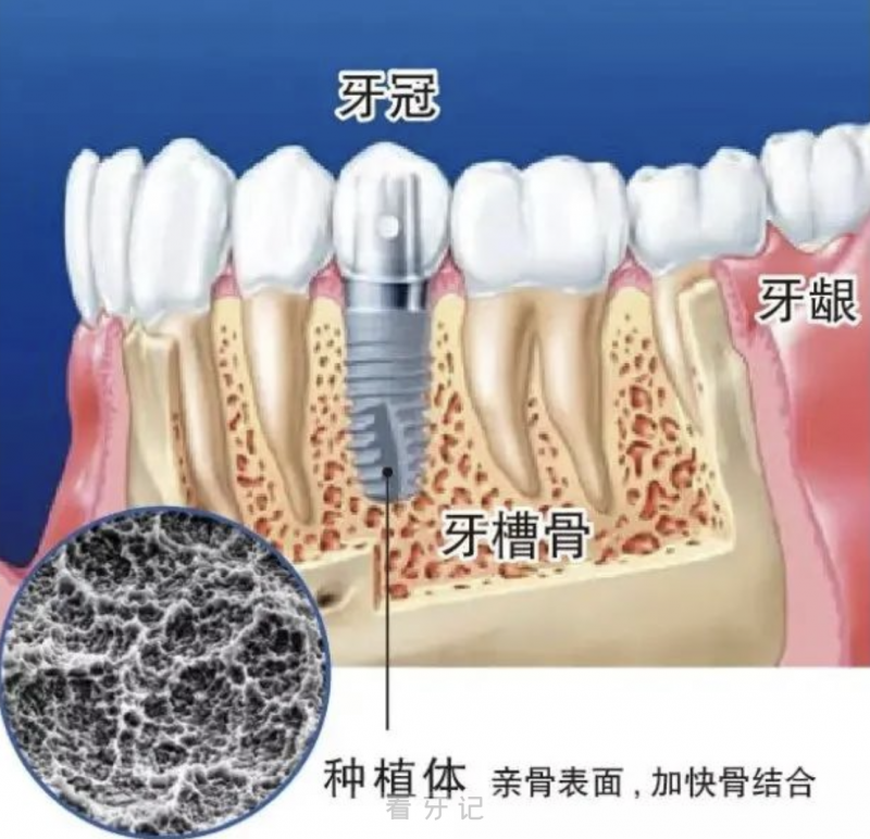 种植牙不会被人体排斥的三大原因