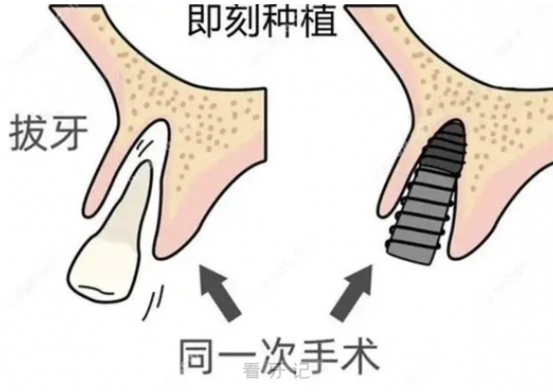 即刻种植费用会比普通种植牙高很多吗？