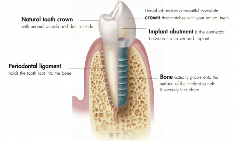 种植牙天然牙结构图对比
