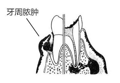 一种会让牙齿掉光的病是什么病？答案揭晓了