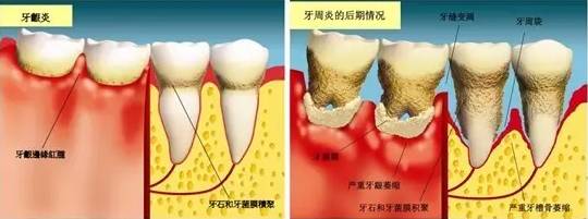 一种会让牙齿掉光的病是什么病？答案揭晓了