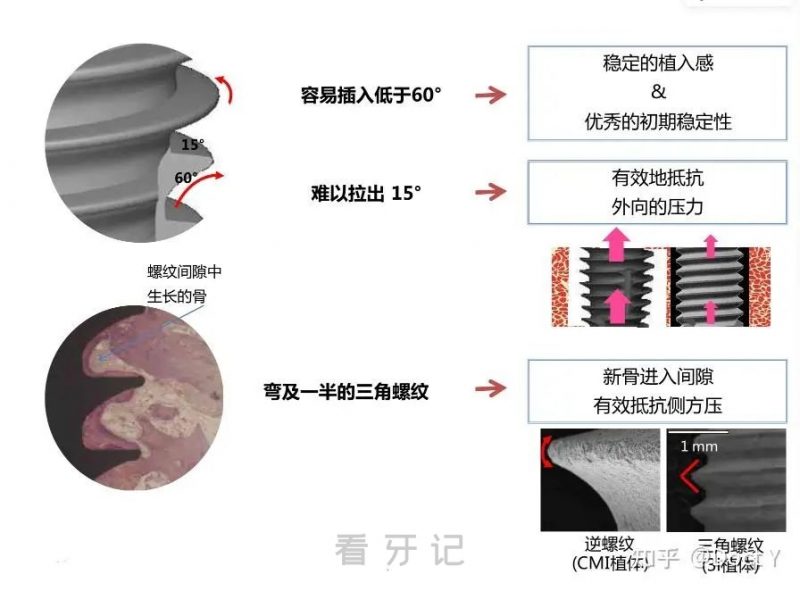 韩国纽白特种植体最新官方介绍