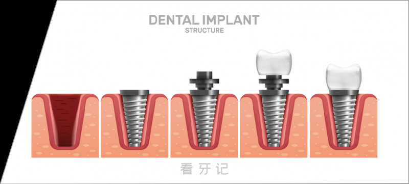 国内认可度高的种植牙四大主流品牌大盘点