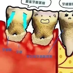 一种会让牙齿掉光的病是什么病？答案揭晓了