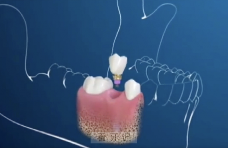 什么是种植牙？有哪些优点？流程是什么？这篇文章能给你说清楚了