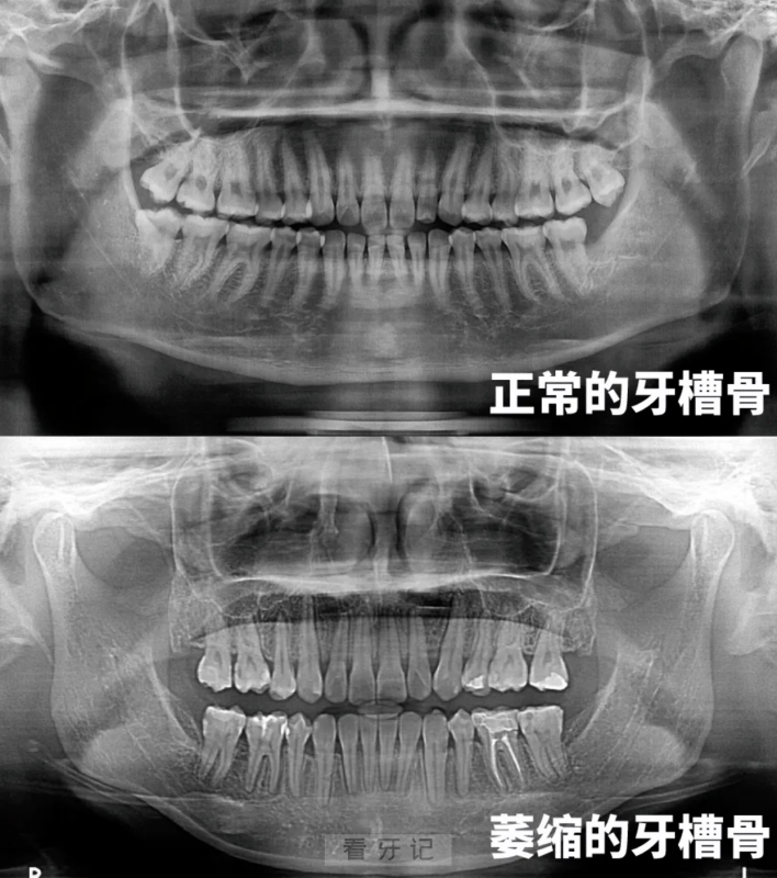 吸烟对种植牙危害有多大？牙槽骨吸收对比图来了