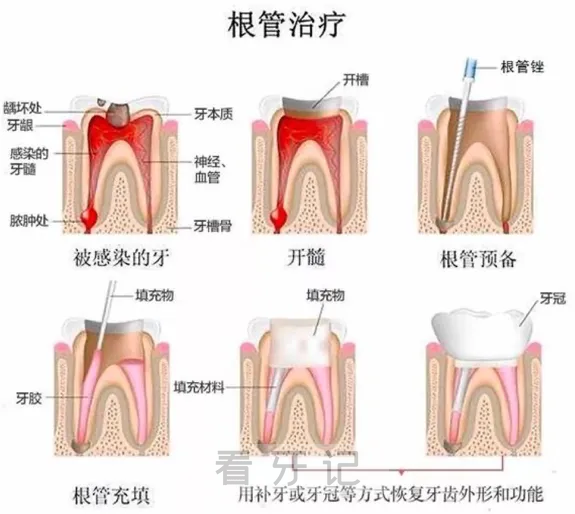 良心牙医说得了牙髓炎吃消炎药没用