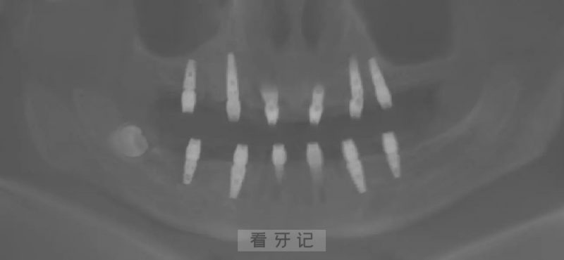 老人缺牙好多颗，种植牙可以做连桥吗？