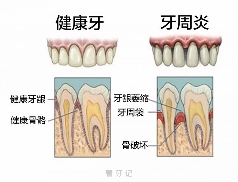 牙周炎和正常牙齿对比图