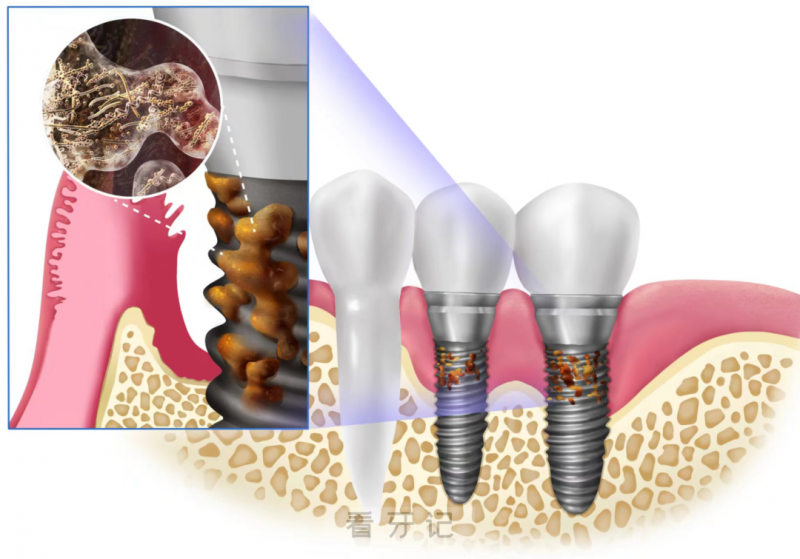 种植体周围炎是怎么形成的