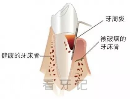 一种会让牙齿掉光的病是什么病？答案揭晓了