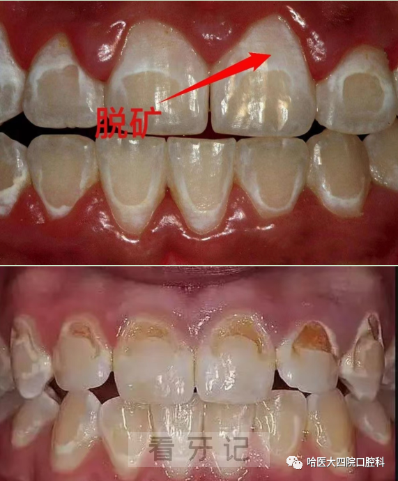 牙齿突然变白（脱矿）真实照片严重版