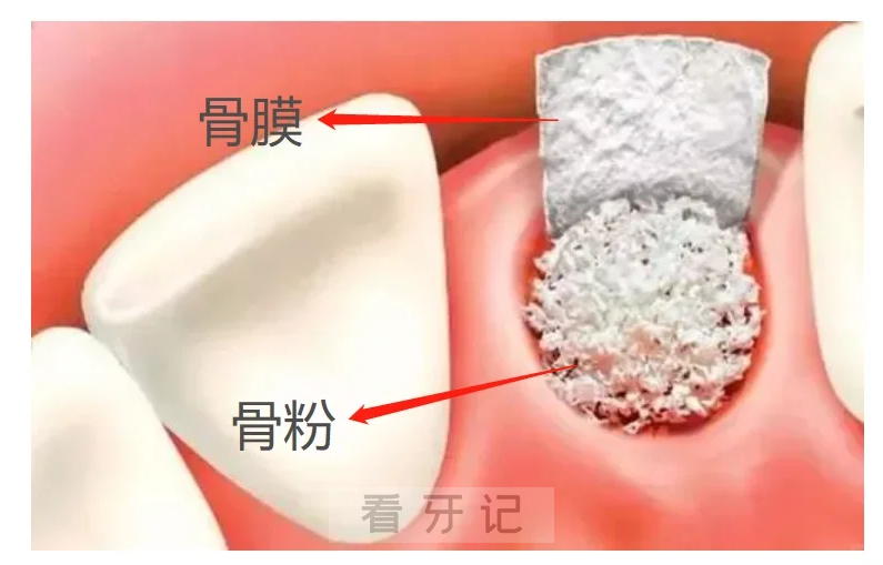 种牙要求加骨粉是不是智商税？谈谈亲身经历