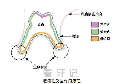 吸附性义齿的原理是什么？