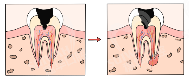 龋齿蛀牙后为什么医生不补牙直接根管治疗