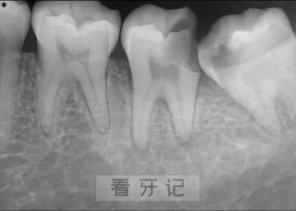 补牙为什么还要让拍片子，可不可以不拍？