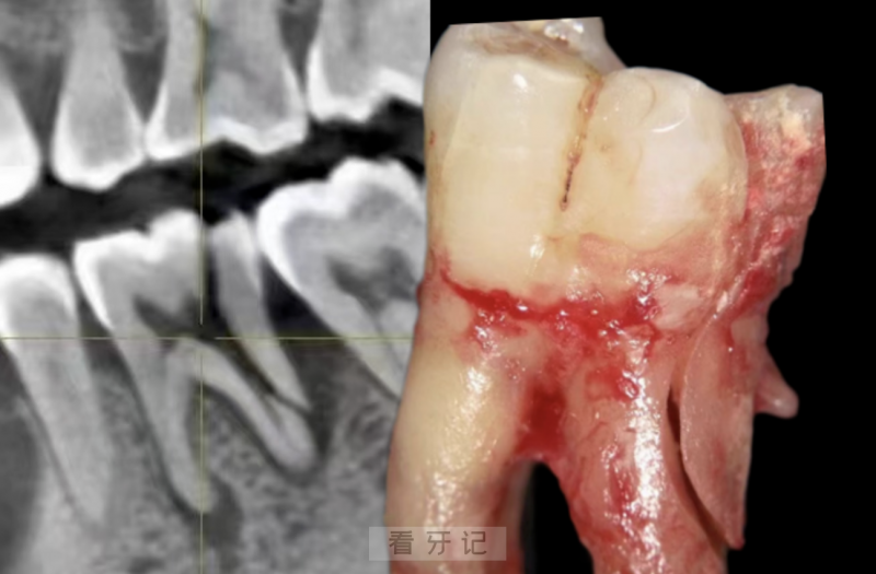 根管治疗牙齿劈成了两半真实图片