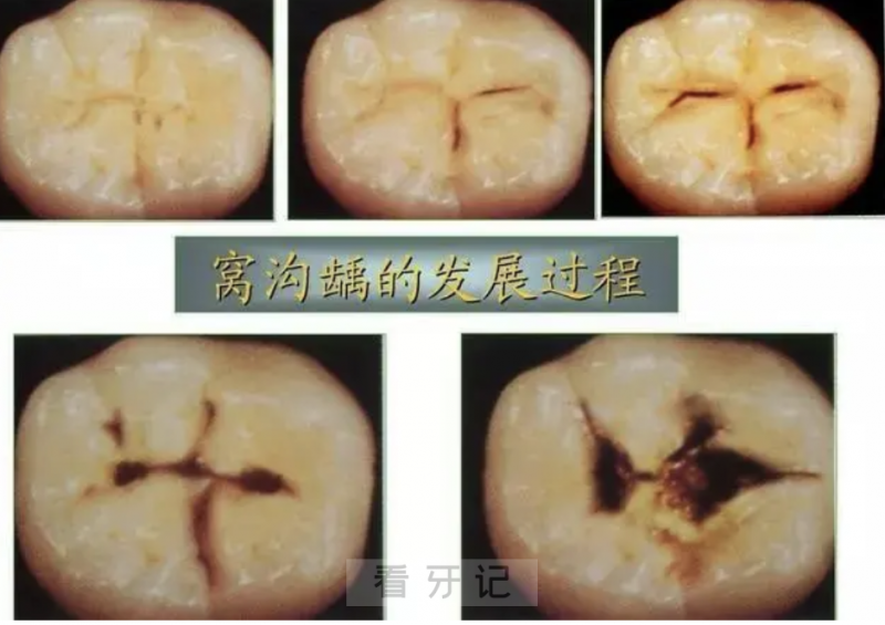 牙齿出现黑线真实图片