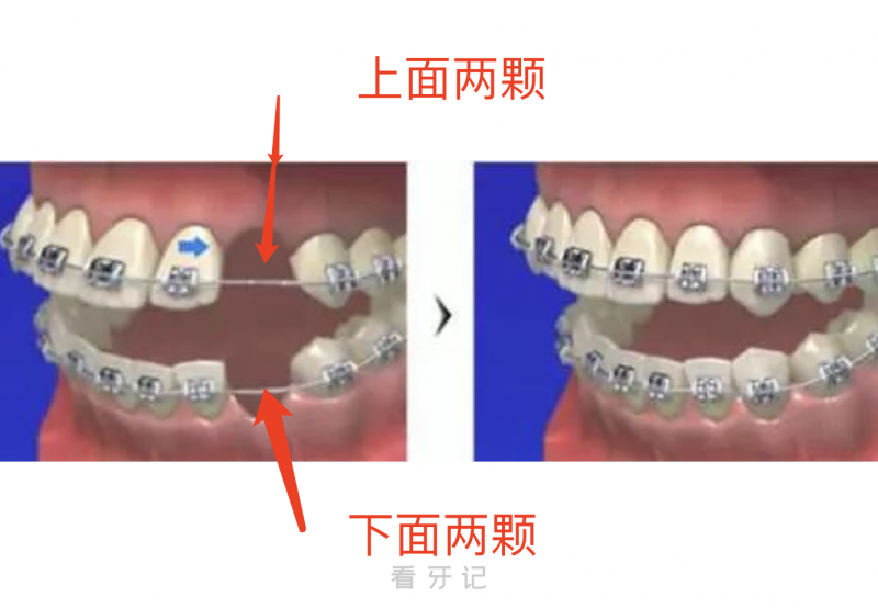 拔牙矫正为什么一下拔四颗好牙