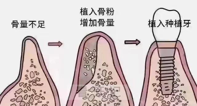 种牙要求加骨粉是不是智商税？谈谈亲身经历